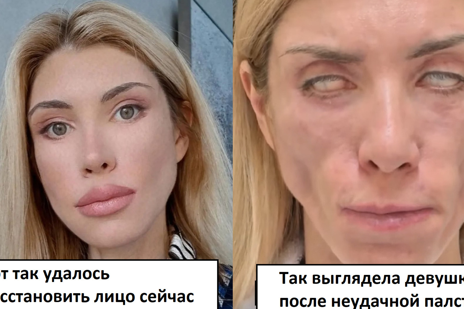 макеева пластика лица до и после фото