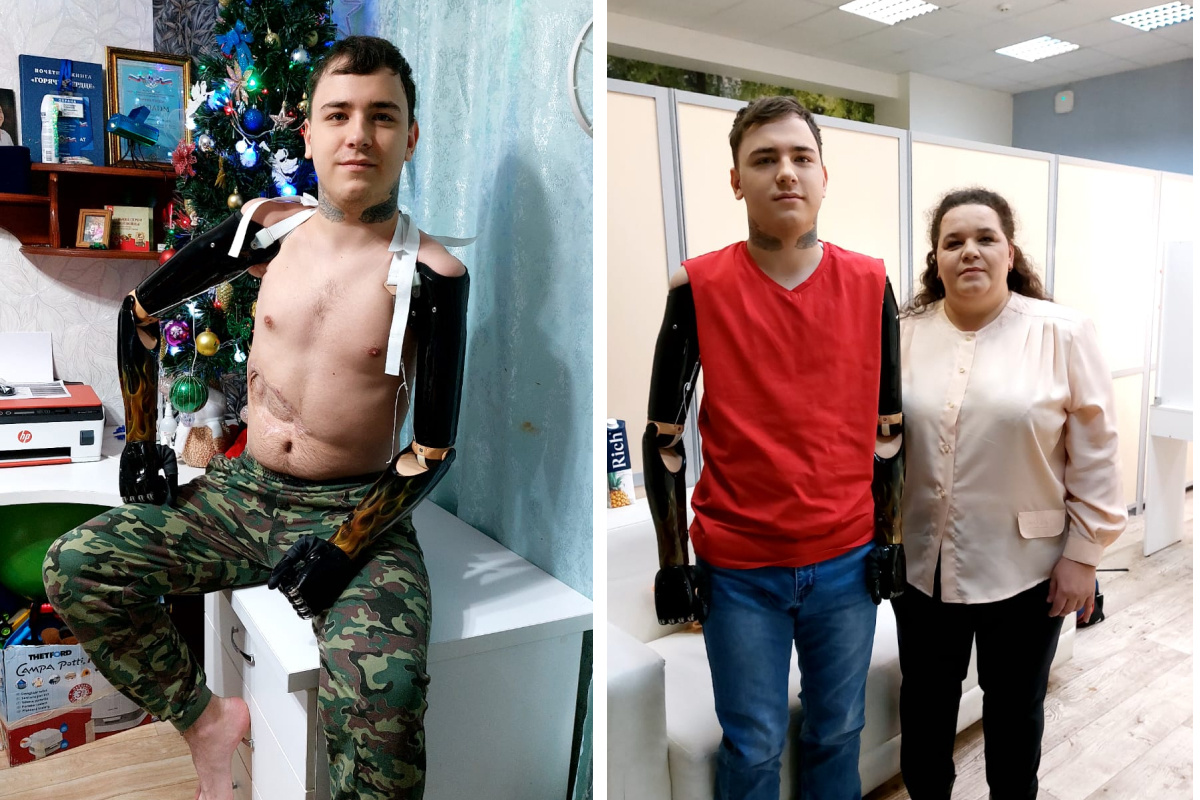 Красноярскому подростку без рук установили протезы почти за 12 миллионов  рублей 14 декабря 2022 г - 14 декабря 2022 - НГС24
