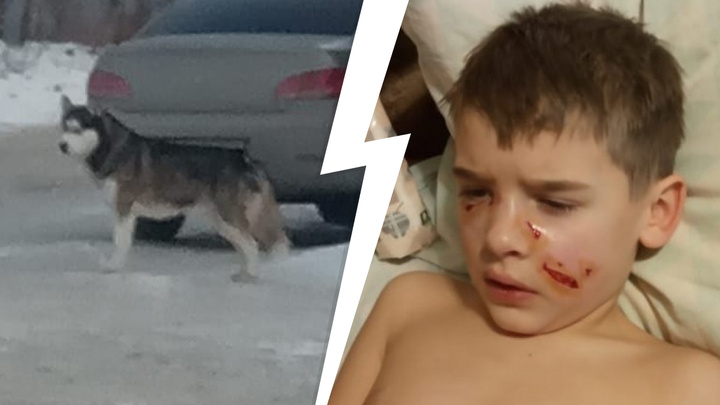 Чиновники заявили, что напавшая на семилетнего мальчика в Челябинске собака не была бездомной