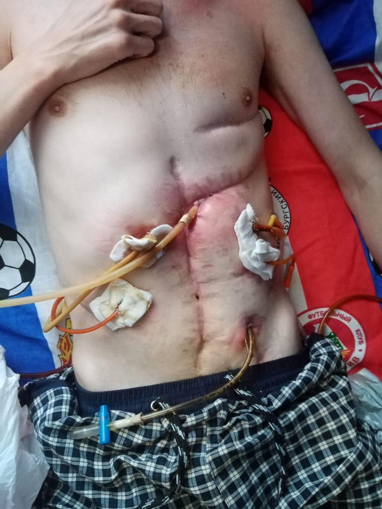 Дмитрий два года провел в лежачем положении, подсоединенный к трубкам Дмитрий два года провел в лежачем положении, подсоединенный к трубкам