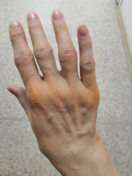 Так выглядели руки Марии в декабре 2019 года, после внутрисуставных инъекций