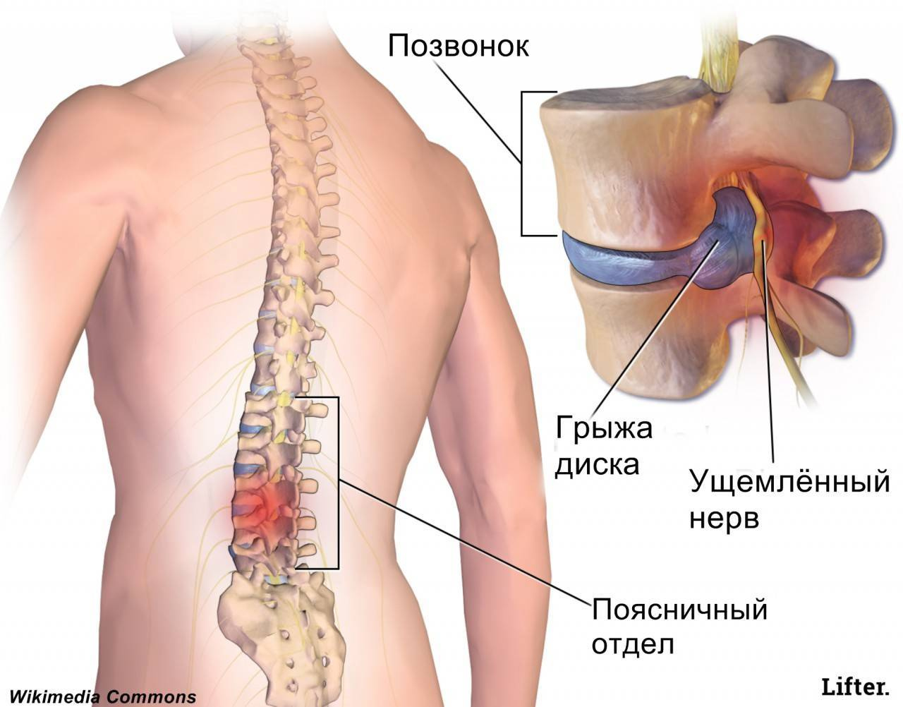 Грыжа диска картинки