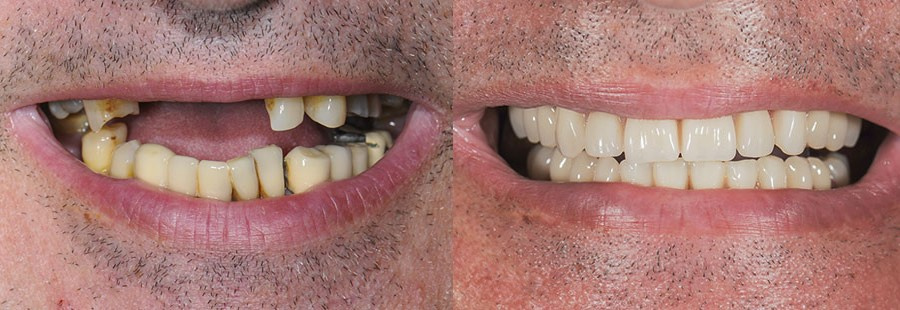 Такая процедура называется «тотальная реабилитация пациентов с отсутствием большинства или всех зубов»