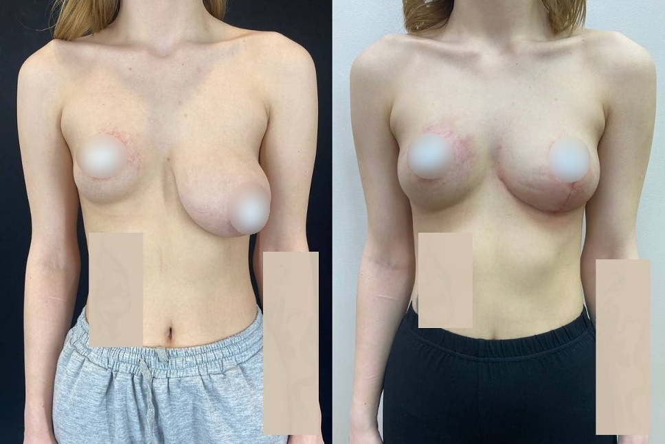 Увеличение одной груди и уменьшение другой, результат через месяц