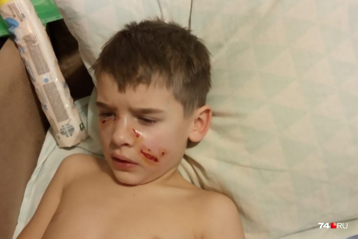 Ребенок в результате нападения пса получил рваные раны лица