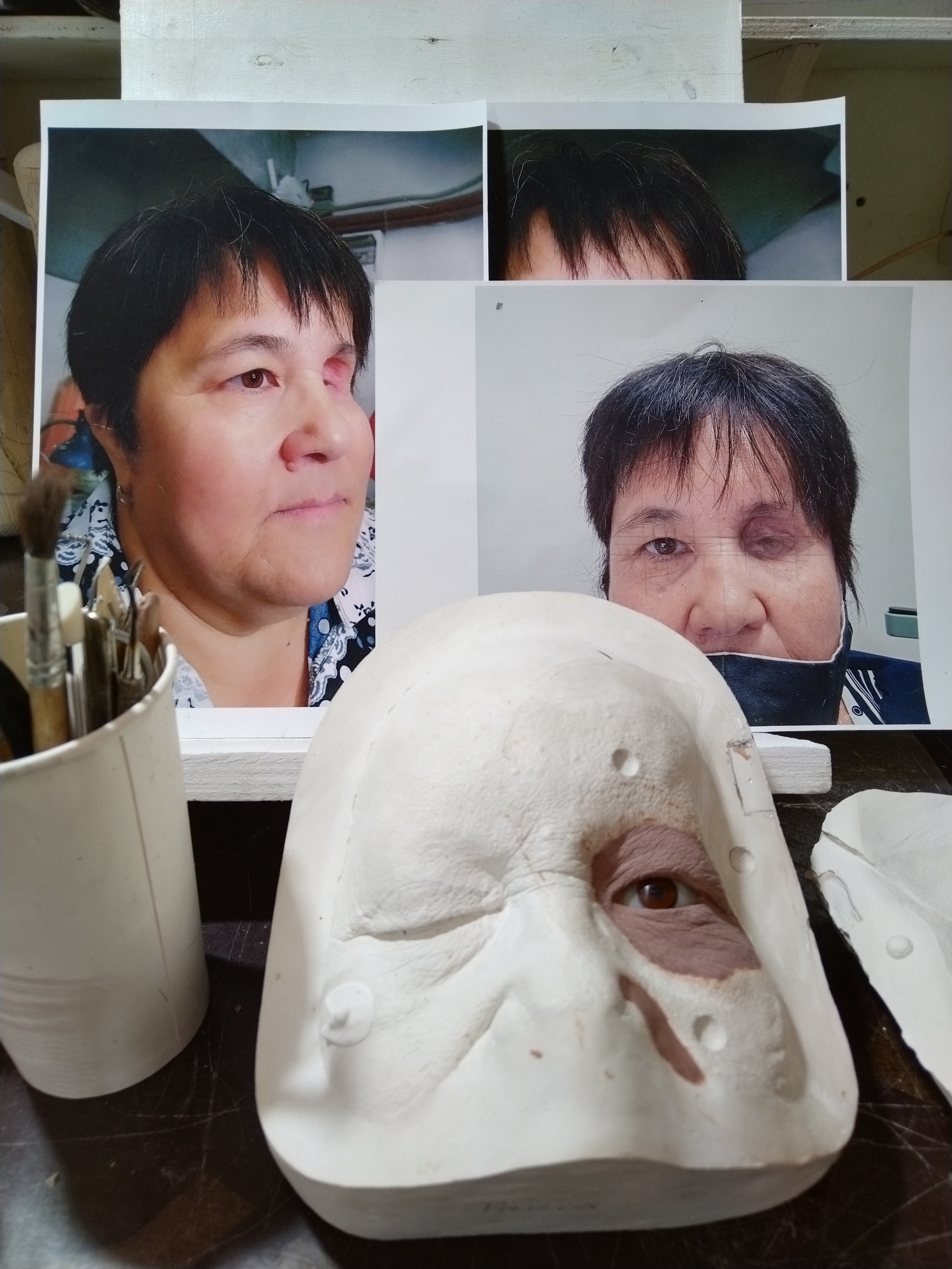 Забыть об эстетических недостатках Елена помогла уже многим южноуральцам Забыть об эстетических недостатках Елена помогла уже многим южноуральцам