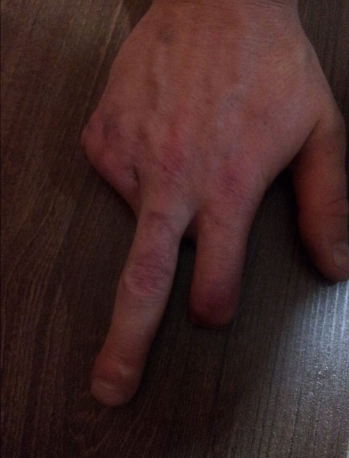 У Николая в колонии была серьезная травма: станком отрубило три пальца на правой руке