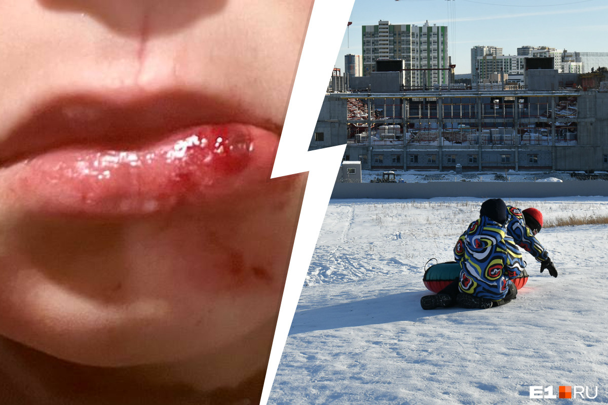 «Снегокат прилетел в лицо»: в Академическом мальчик получил травму во время катания с горки
