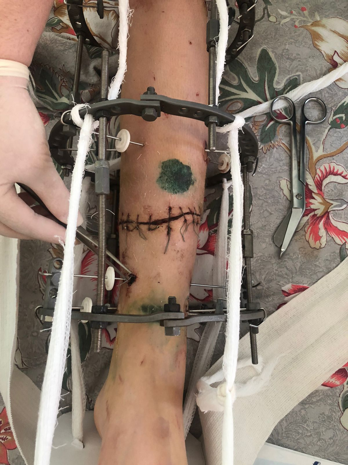 Кости на правой ноге начинают срастаться, а на левой — пока нет никаких обсуждений Кости на правой ноге начинают срастаться, а на левой — пока нет никаких обсуждений