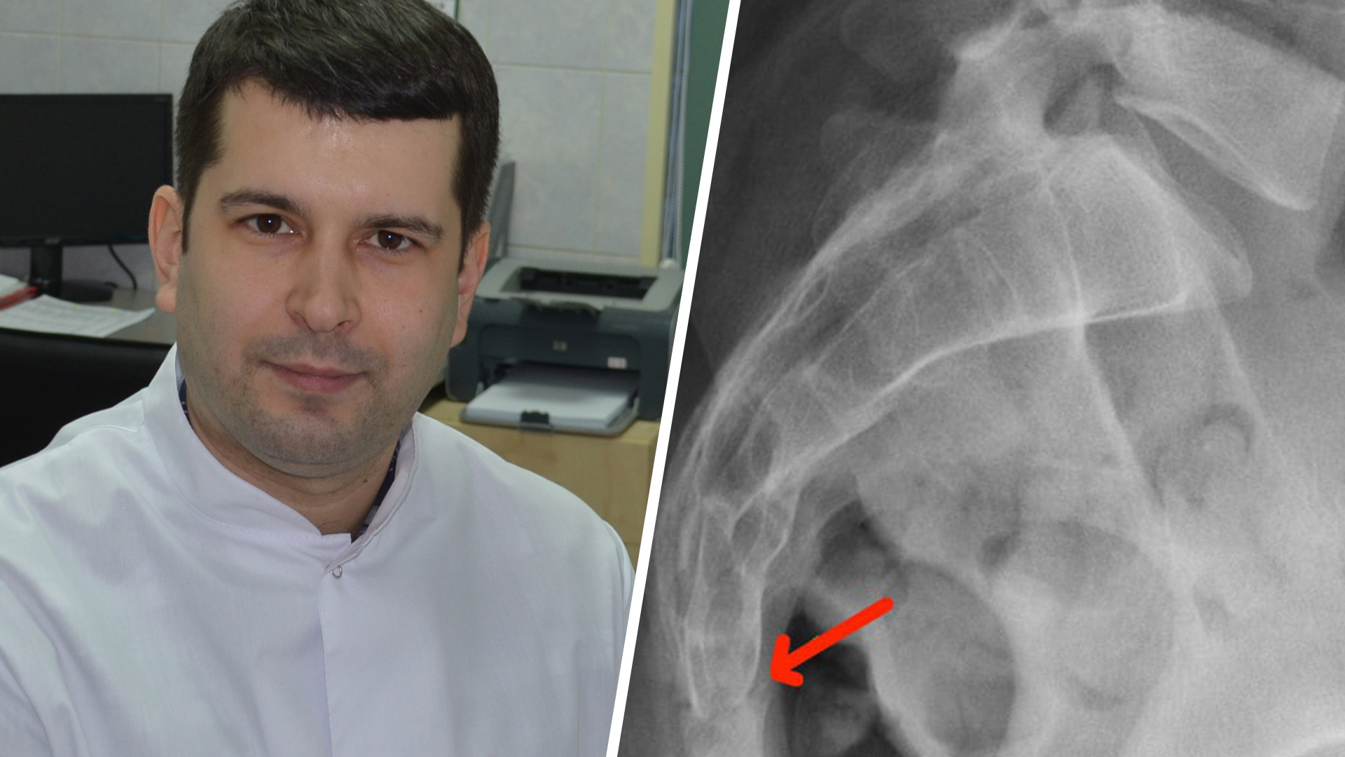 Травматолог-ортопед Курганской детской поликлиники рассказал, чем чреваты переломы копчика у детей