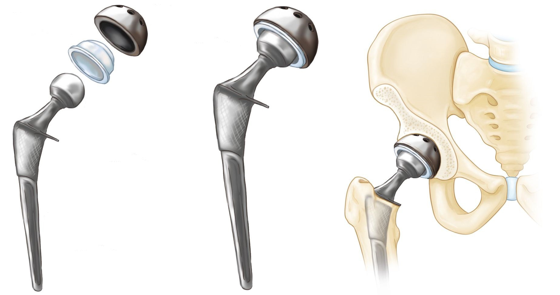 Эндопротез тазобедренного сустава DEPUY