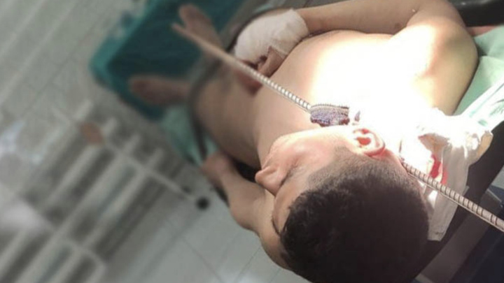 В подмосковной больнице врачи вытащили 1,5-метровую арматуру из шеи мужчины