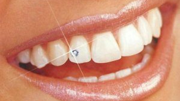 Клиника «Профи» подарит клиентам украшения на зубы