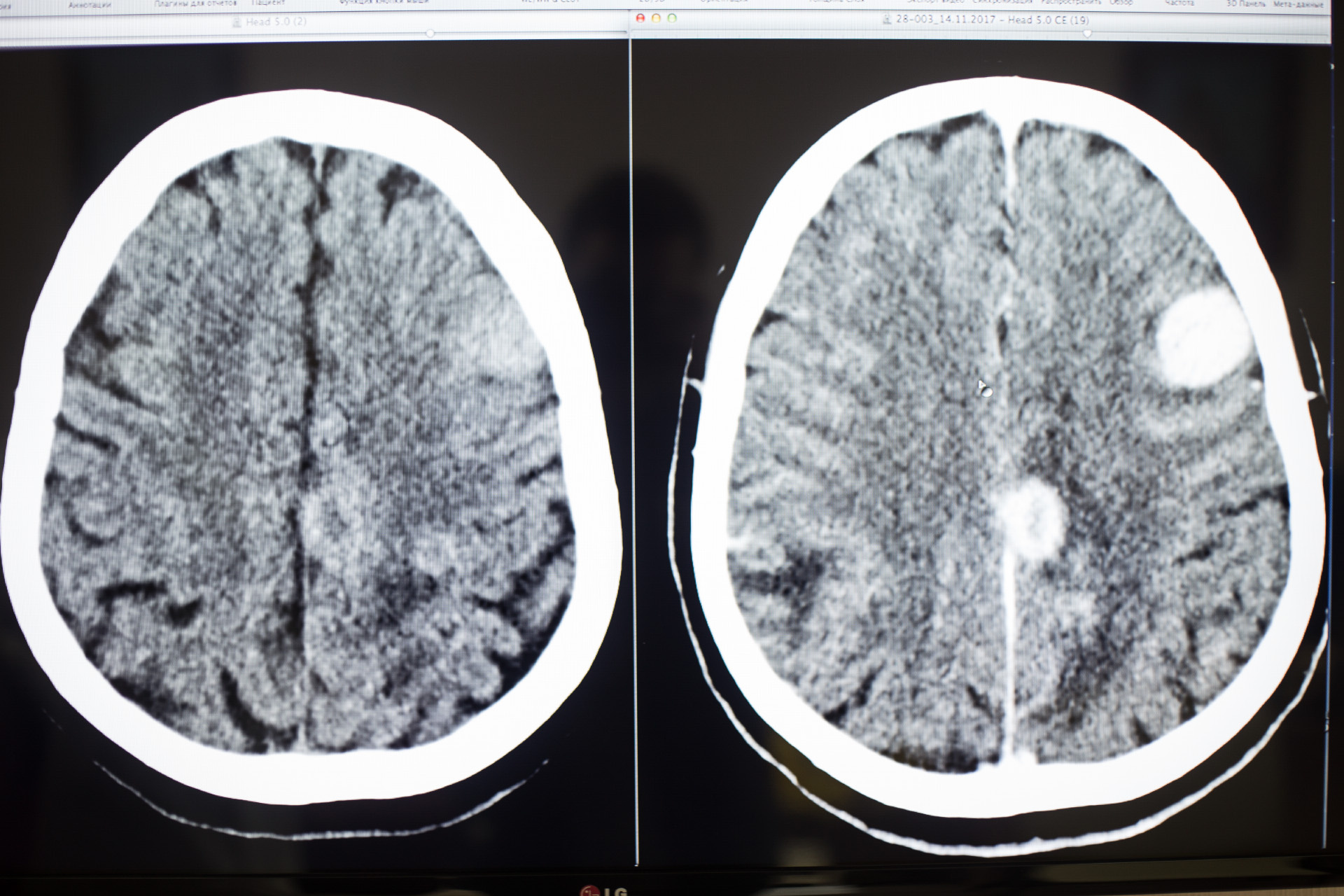 Кт или мрт. Опухоль головного мозга мрт с контрастом. Глиомы на кт с контрастированием головного мозга. Опухоль головного мозга на кт с контрастом. МСКТ опухоли головного мозга.