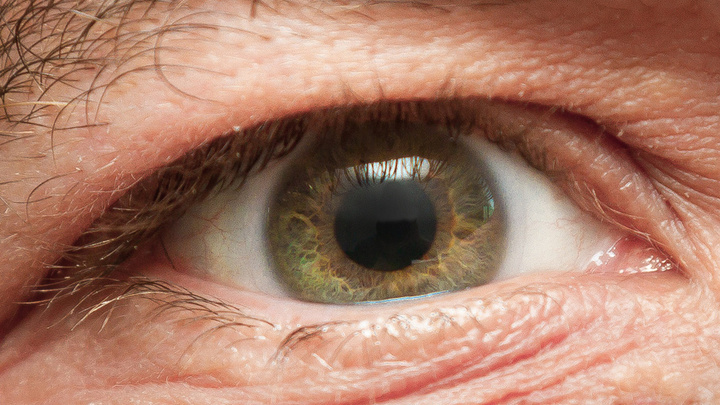 Южноуральцу, потерявшему зрение, первому в России установили бионический глаз