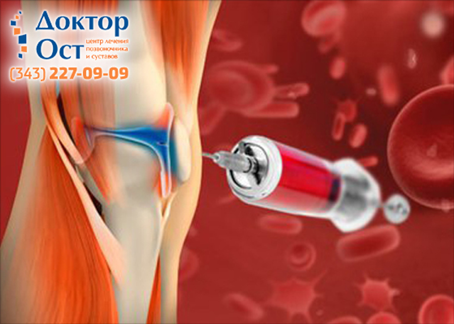 Prp терапия коленного сустава. Prp плазмотерапия. Prp терапия для суставов что это такое. Prp плазмолифтинг суставов. Плазмотерапия суставов (prp-терапия, плазмолифтинг).