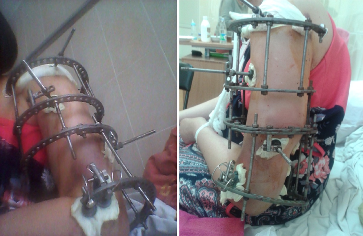 После двух недель на вытяжке и сложной операции челябинке установили аппарат Илизарова