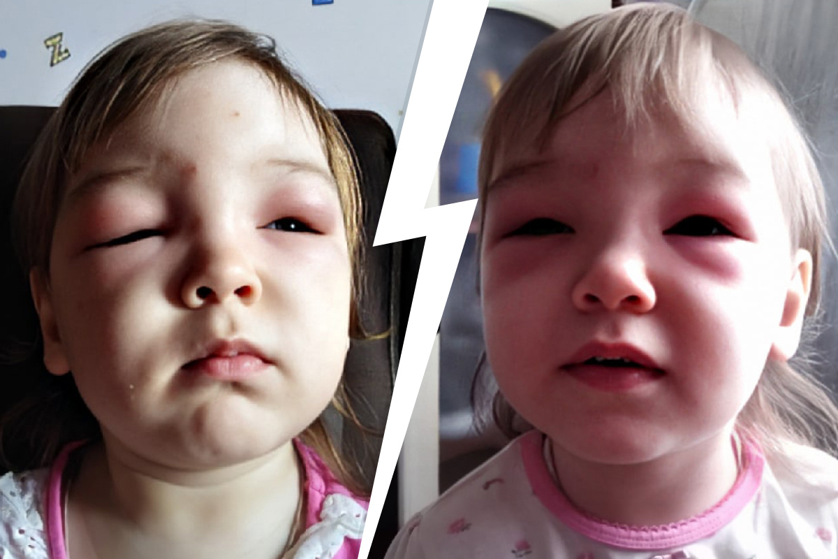 «Моего ребенка укусил ребенок!» | l2luna.ru