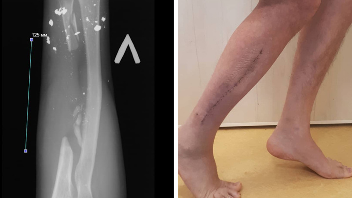 В Красноярске мужчине пересадили часть кости ноги в руку, чтобы сохранить функции конечности