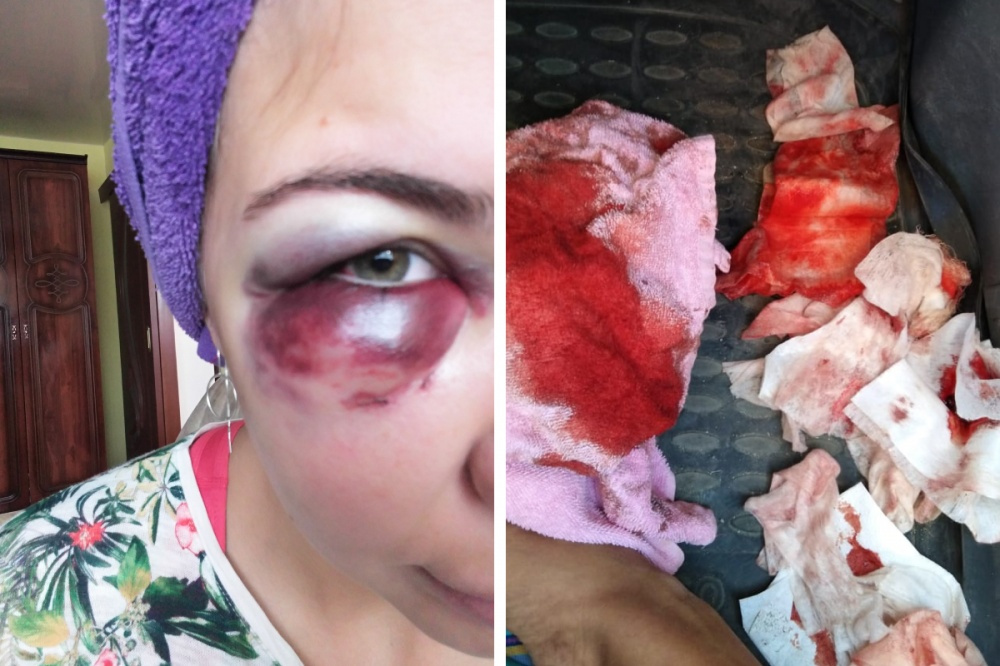 В таком виде одна из отдыхающих уехала с Таватуя после конфликта В таком виде одна из отдыхающих уехала с Таватуя после конфликта