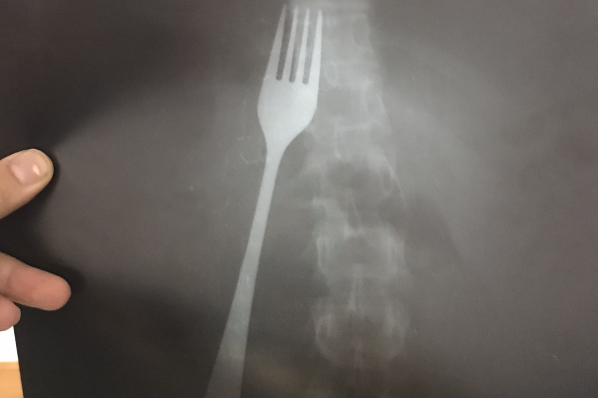 Рентгеновский снимок 2 вилок в пищеводе