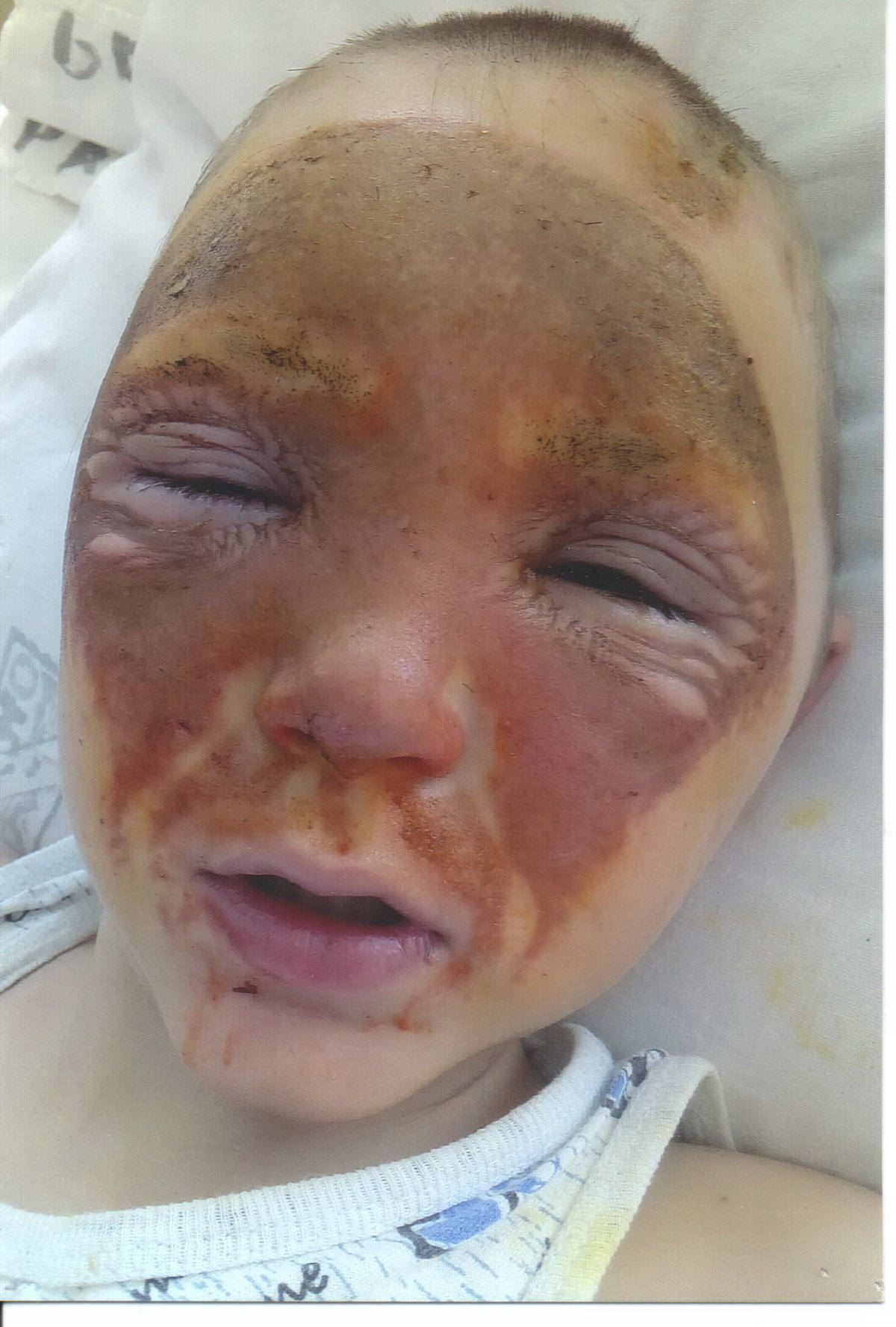 Мальчик получил серьезные ожоги: фото сделано вскоре после происшествия 