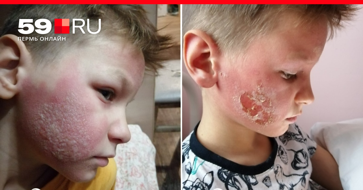 В Перми в ТЦ «Кит» на Гайве дети госпитализированы с сильной аллергией - 5  марта 2020 - 59.ru