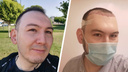 «Стал выглядеть моложе»: сибиряк начал лысеть и сделал пересадку волос — подробности необычного опыта (до и после)