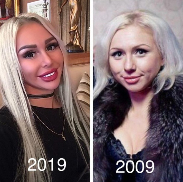 Пластика лица: фото до и после