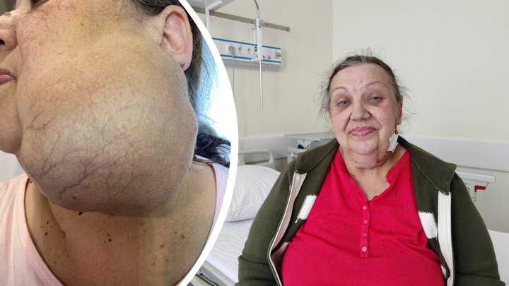 У пенсионерки на лице хирурги вырезали 1,5-килограмовую опухоль. 12 лет она ее «не беспокоила»