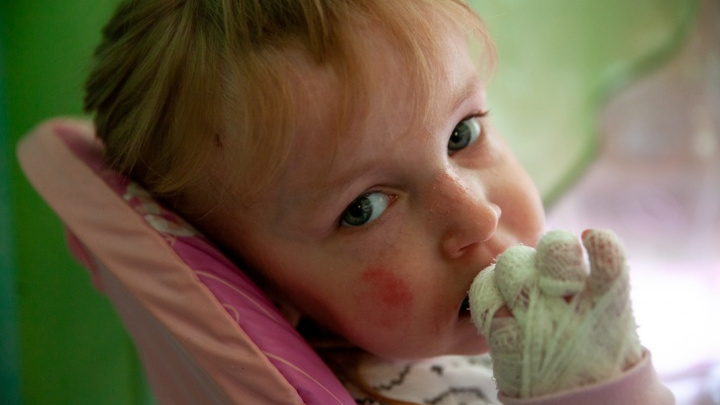Девочке-бабочке из Ишима требуется госпитализация. Лечить ребенка с редким заболеванием будут в Москве