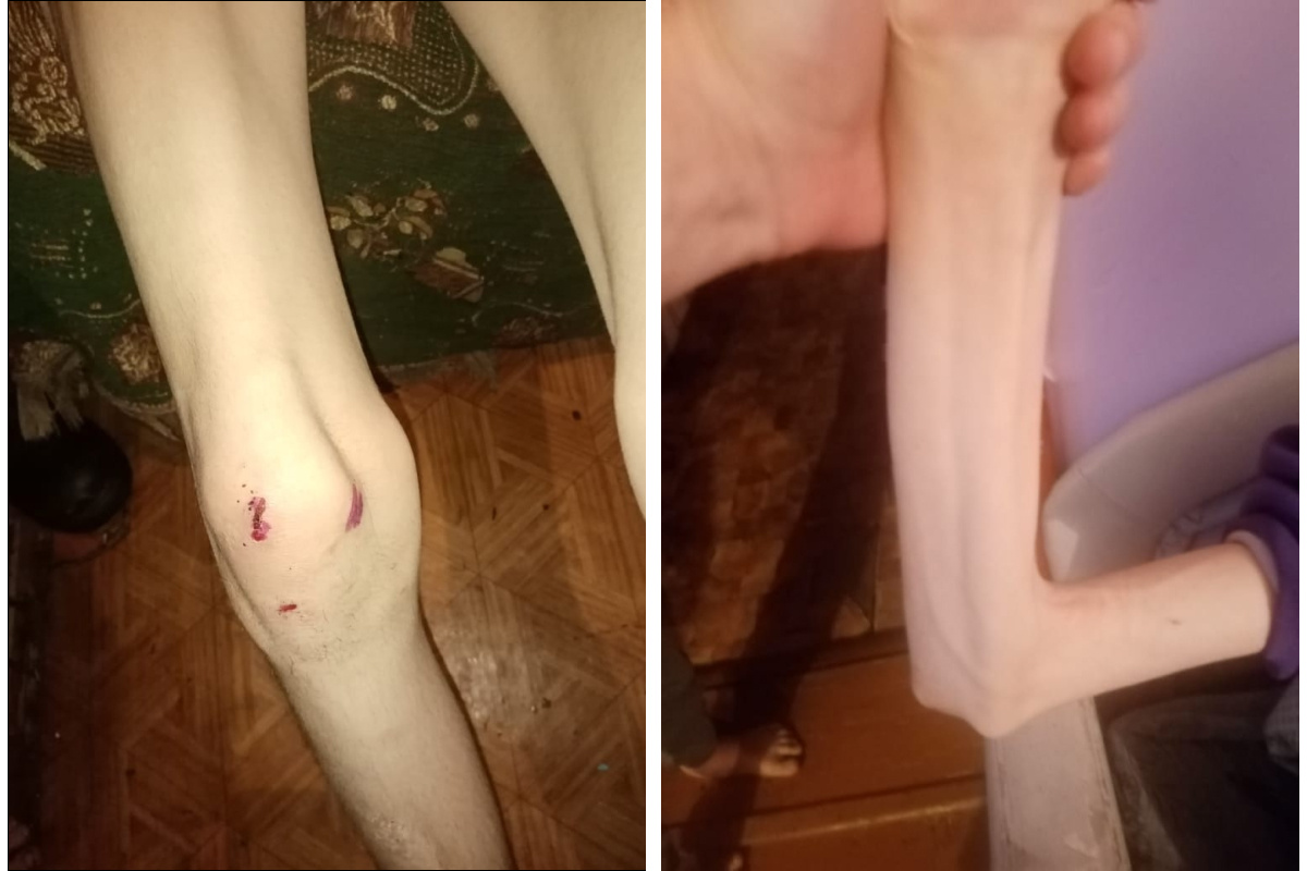 Сейчас подросток сильно истощен, хотя еще год назад, по словам родных, был в хорошей физической форме Сейчас подросток сильно истощен, хотя еще год назад, по словам родных, был в хорошей физической форме