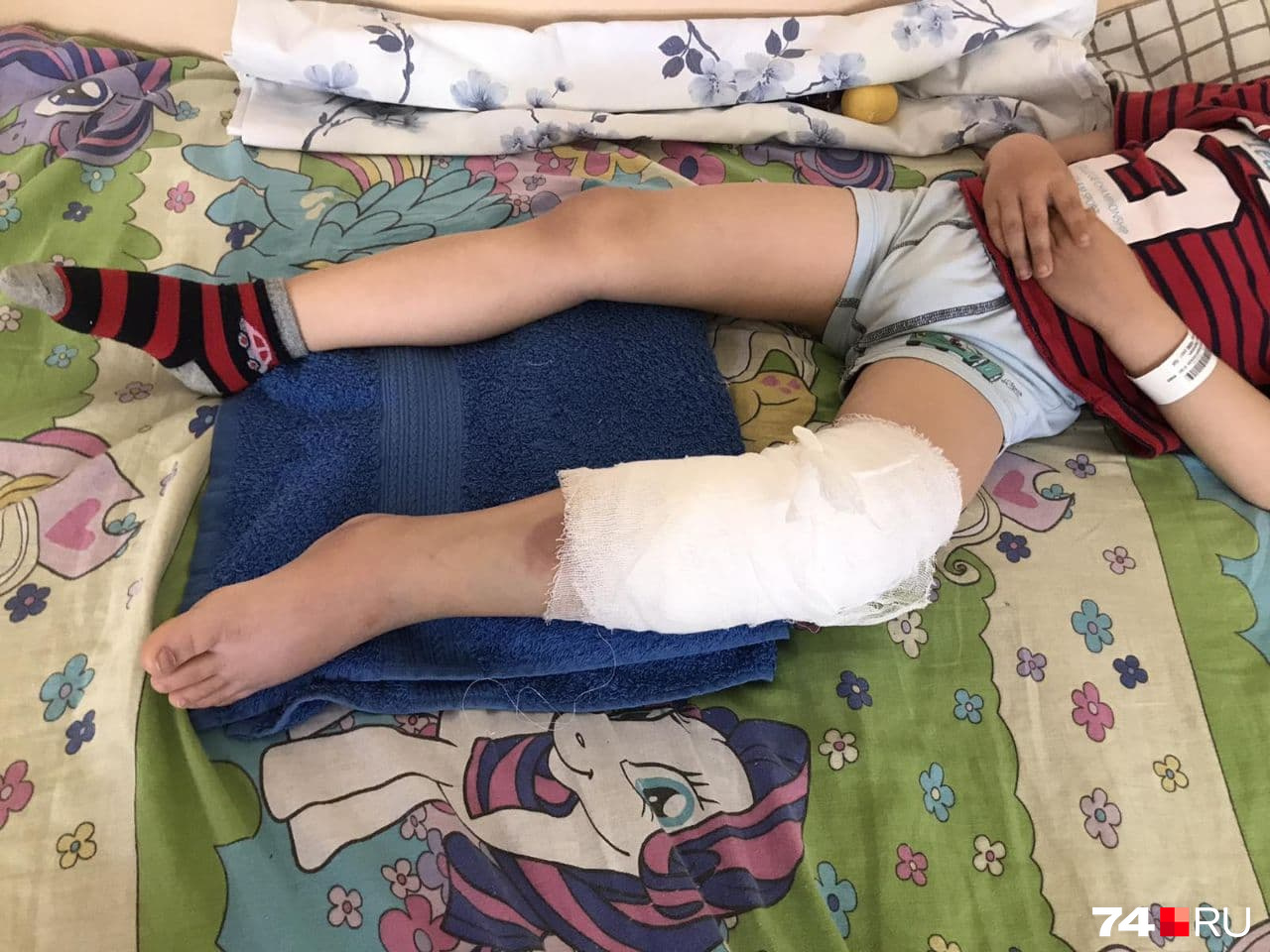 Мальчику сперва наложили гипс, а потом сделали операцию на ноге