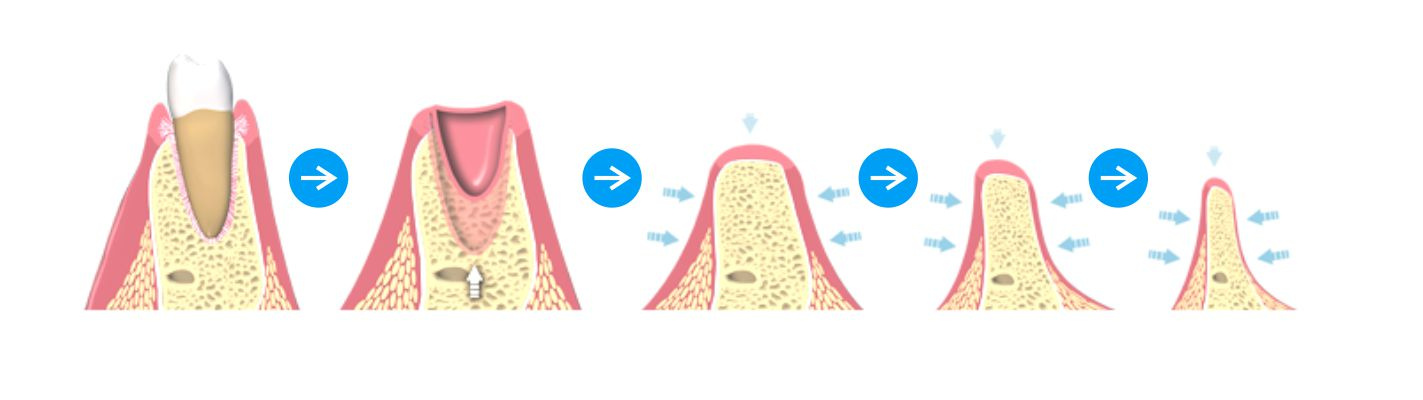 Восстановление костной ткани зубов. Атрофирование костной ткани десны. Пластика альвеолярного отростка мембранной. Регенерация костной ткани челюсти.