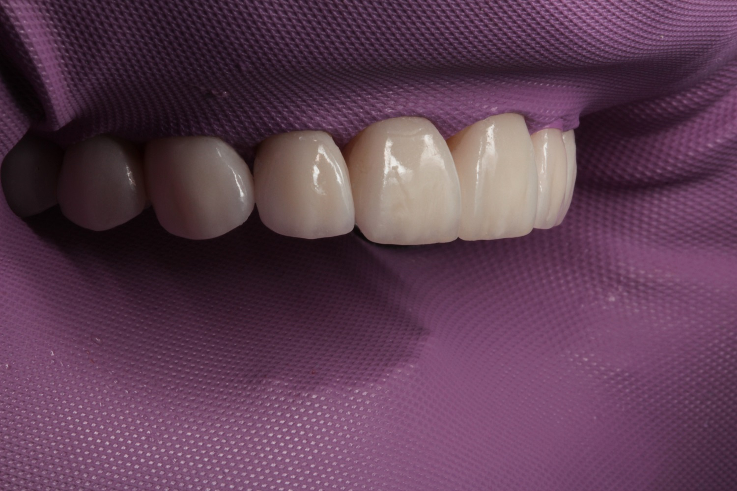 Работа стоматолога-ортопеда Виктории Бурдо, зубного техника Романа Зайкова<br>