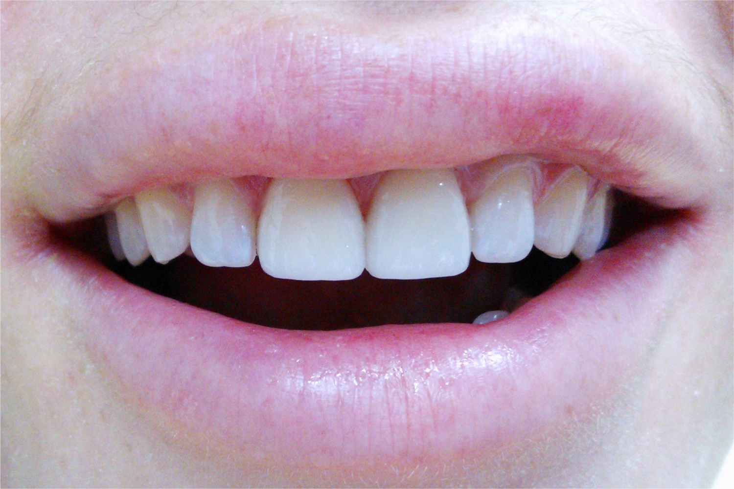 Коронки из диоксида циркония от немецкой стоматологии RecomenDent