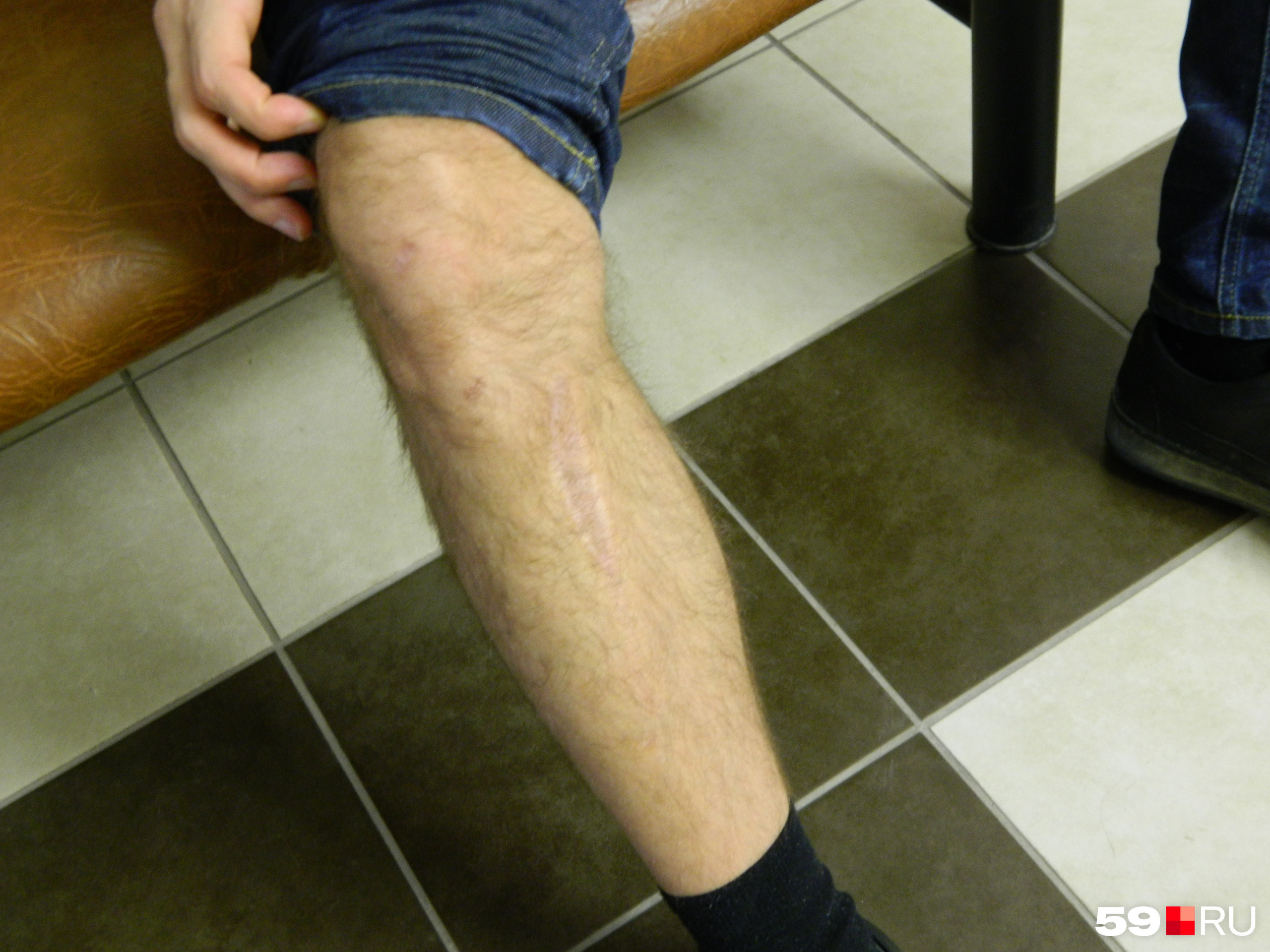 Никита закатывает штанину на правой ноге, показывает отметины — шрамы и длинный рубец