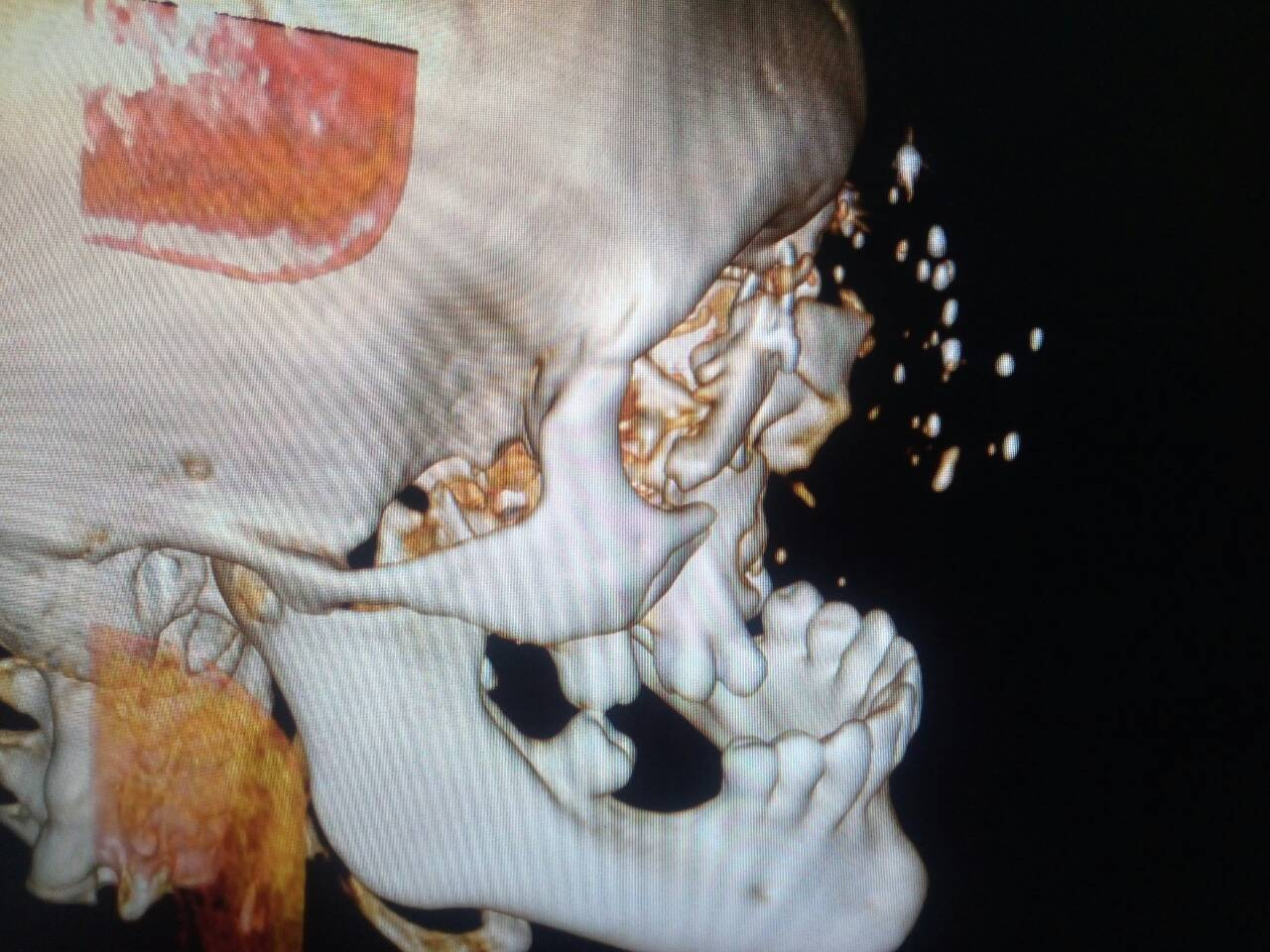Снимок пострадавшего от выстрела пациента. На реальном фото с операции видно, что лицо оказалось полностью раздроблено. С первого взгляда людей, не связанных с медициной, представить, что с такими ранами люди выживают, сложно