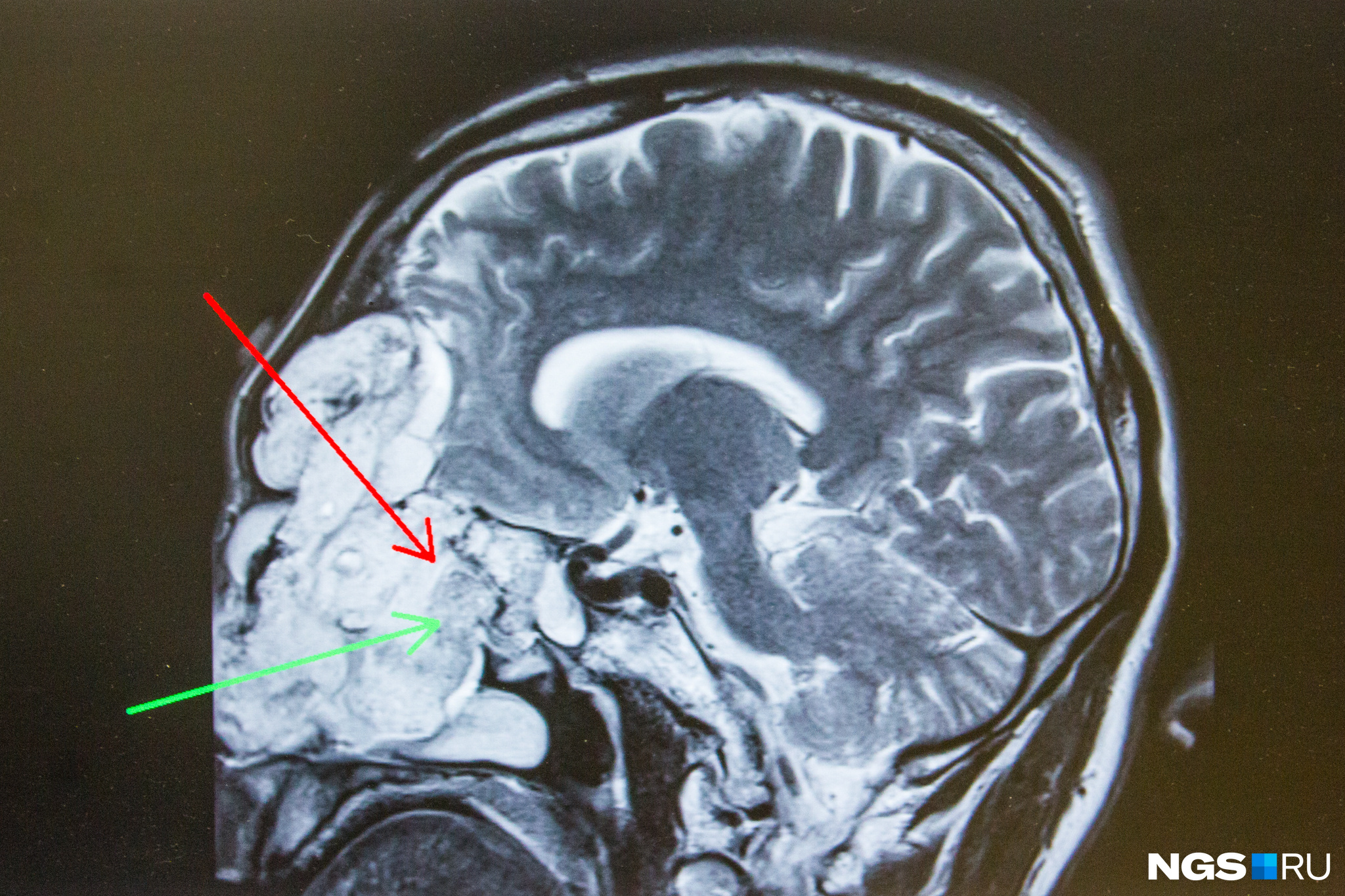 Опухоль в голове. Новообразование на голове. Опухоль растущая из оболочек головного мозга. Опухоль мозга в голове снимки женские.