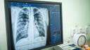 Врачи объяснили детскую «эпидемию» туберкулёза в Копейске