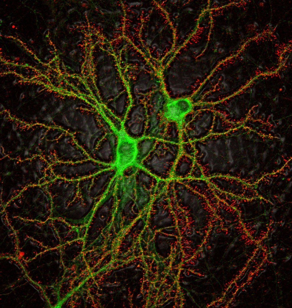 Как болезнь Альцгеймера убивает нейроны. На снимке, отмеченном жюри конкурса Nikon Small World, мы видим нейроны гиппокампа крысы (зеленые), «атакованные» олигомерами амилоида бета (красные), токсичными для нейронов. Именно это вызывает гибель нейронов гиппокампа и потерю памяти