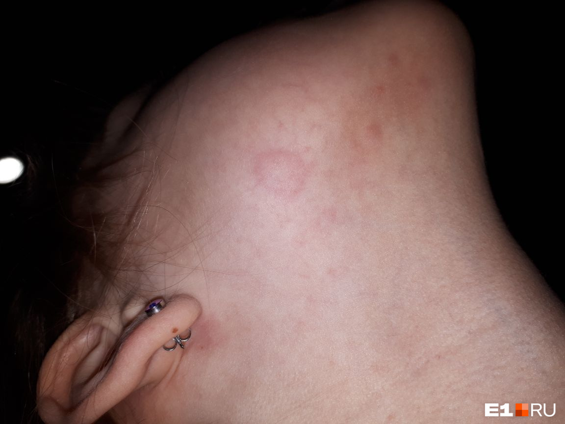 Как выглядит аллергия на стиральный порошок у детей и взрослых: фото