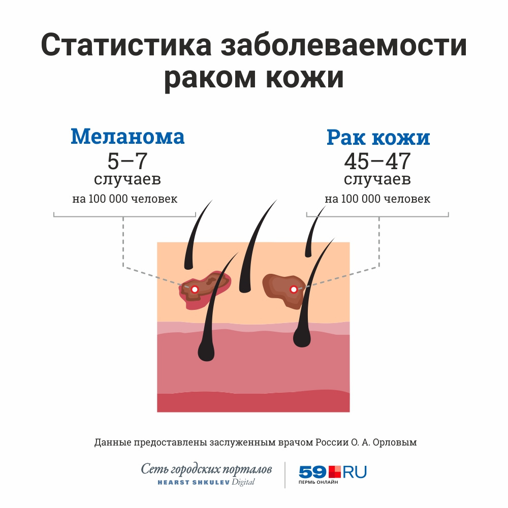 Меланома психосоматика. Частота возникновения меланомы. Меланома кожи классификация. Распознавание меланомы.