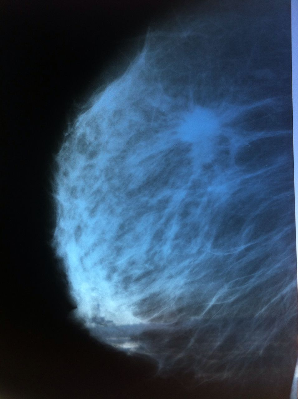 Проявления и первые симптомы рака груди на ранних стадиях: профилактика  рака груди - 17 октября 2017 - НГС24