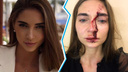 Сибирячка сцепилась с косметологом: одна разбила в кровь лицо, другая попала на сохранение