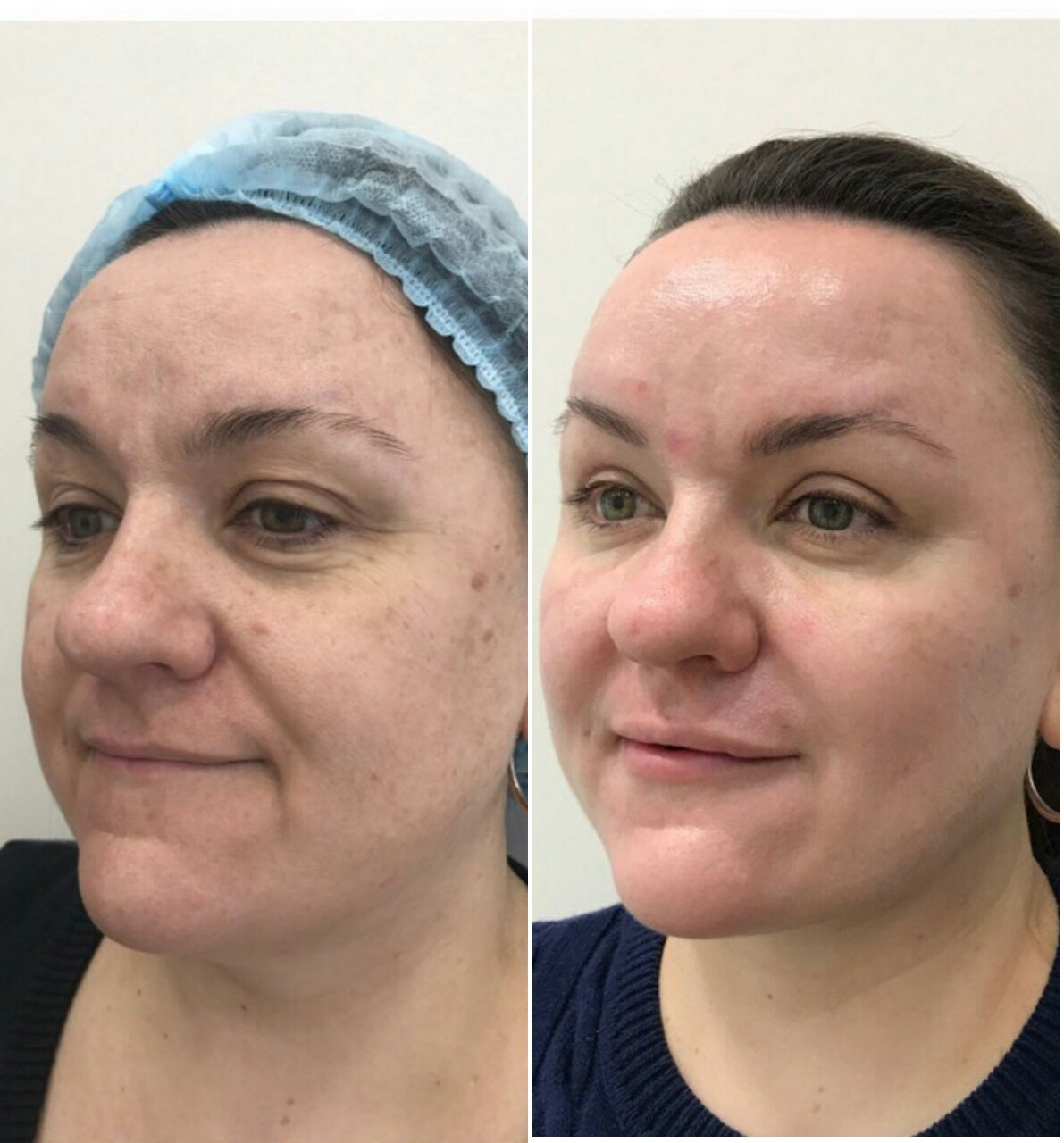 Фото слева — Елена пришла к косметологу. Фото справа — через месяц изменений <br>