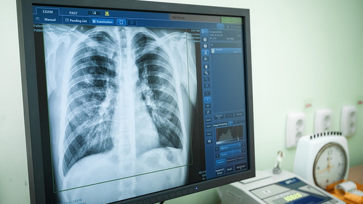«Просветили» иностранца: челябинские врачи рассказали, как нашли туберкулёз у студента-индонезийца