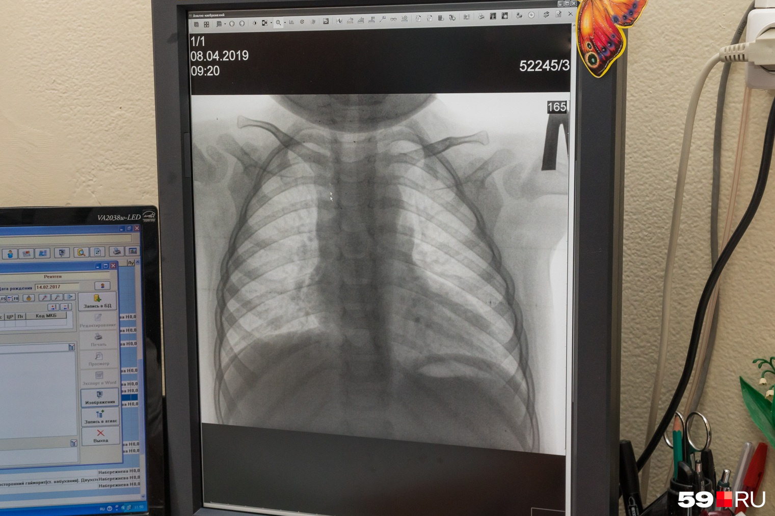 «Просветили» иностранца: челябинские врачи рассказали, как нашли туберкулёз у студента-индонезийца