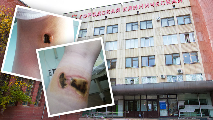 «Готовят к пересадке кожи»: 16-летняя челябинка получила ожоги ног, попав в больницу с аппендицитом