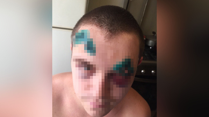 Врачи наложили 21 шов: в Ярославле жестоко избили молодого мужчину